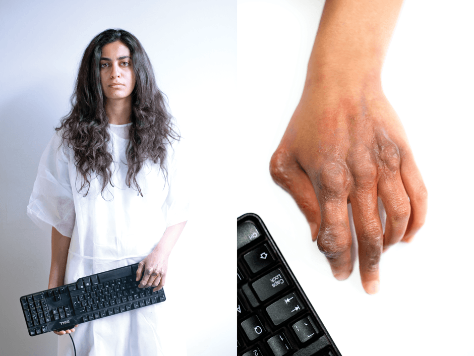 Girl holds keyboard in hospital gown and shows an injured hand caused by WASD syndrome 