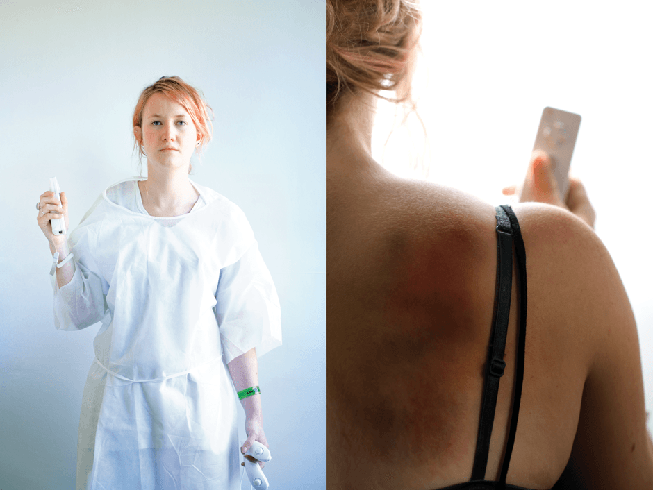 woman holds wiimote and shows bruise on shoulder from wii shoulder dislocation