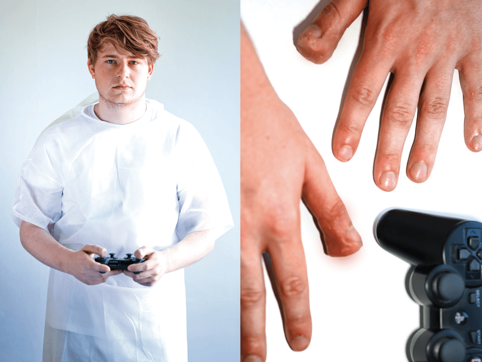 man with playstation controller and swollen hand