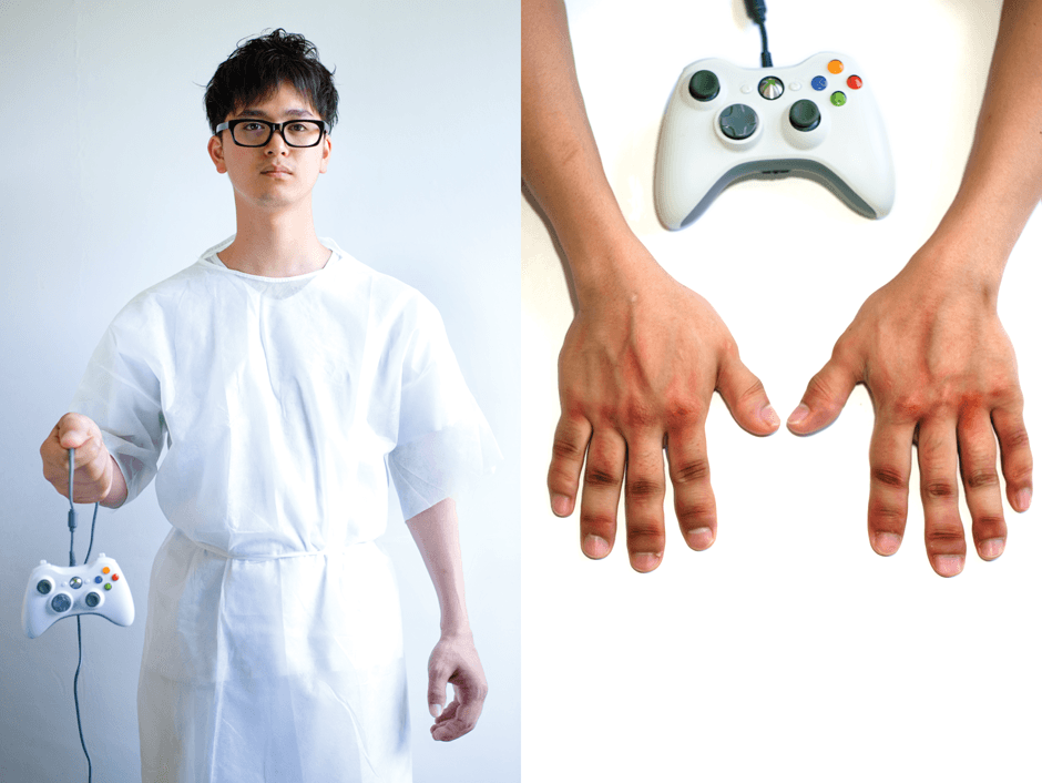 man dangles xbox remote and shows swollen infected fingers on gaming hands