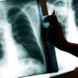 TB, tuberculosis, Washington state, casinos
